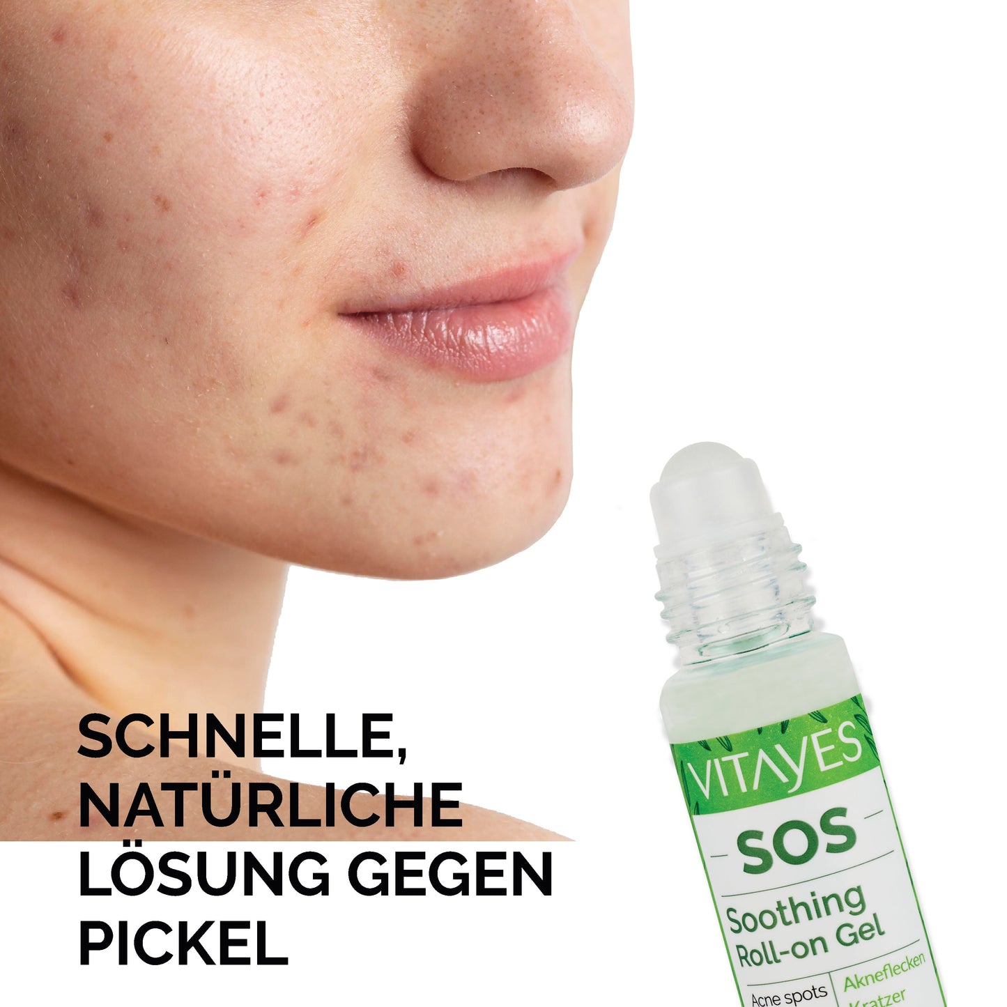 SOS Teebaumöl – Akut-Hilfe bei Pickeln, Rötungen & Hautreizungen 3 Stk. (30 ml)